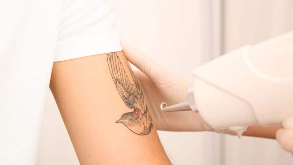 remoção de tatuagem