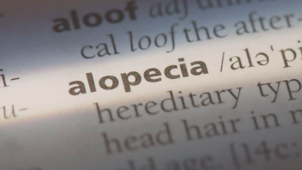 Alopecia androgenética