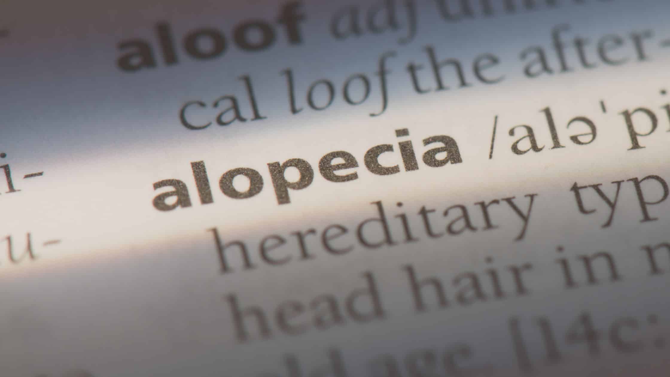 Alopecia androgenética