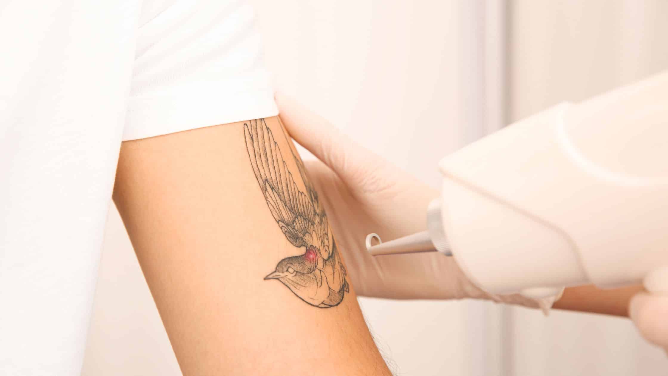 remoção de tatuagem