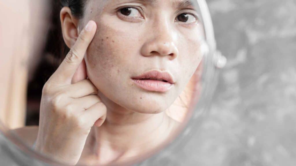 Melasma: causas, gatilhos e os tratamentos mais modernos para controlar as manchas