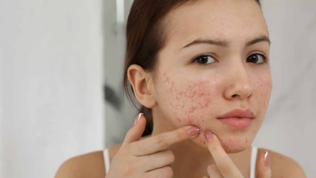 Entenda a Acne: conheça os diferentes graus e os melhores tratamentos para uma pele saudável