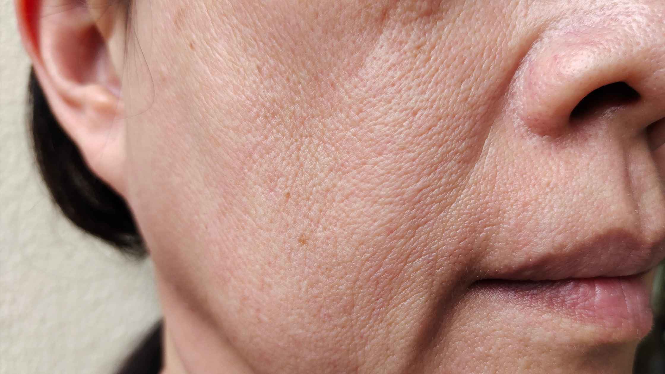 Laser Preventivo: Quando Iniciar os Tratamentos para Flacidez e Linhas Finas